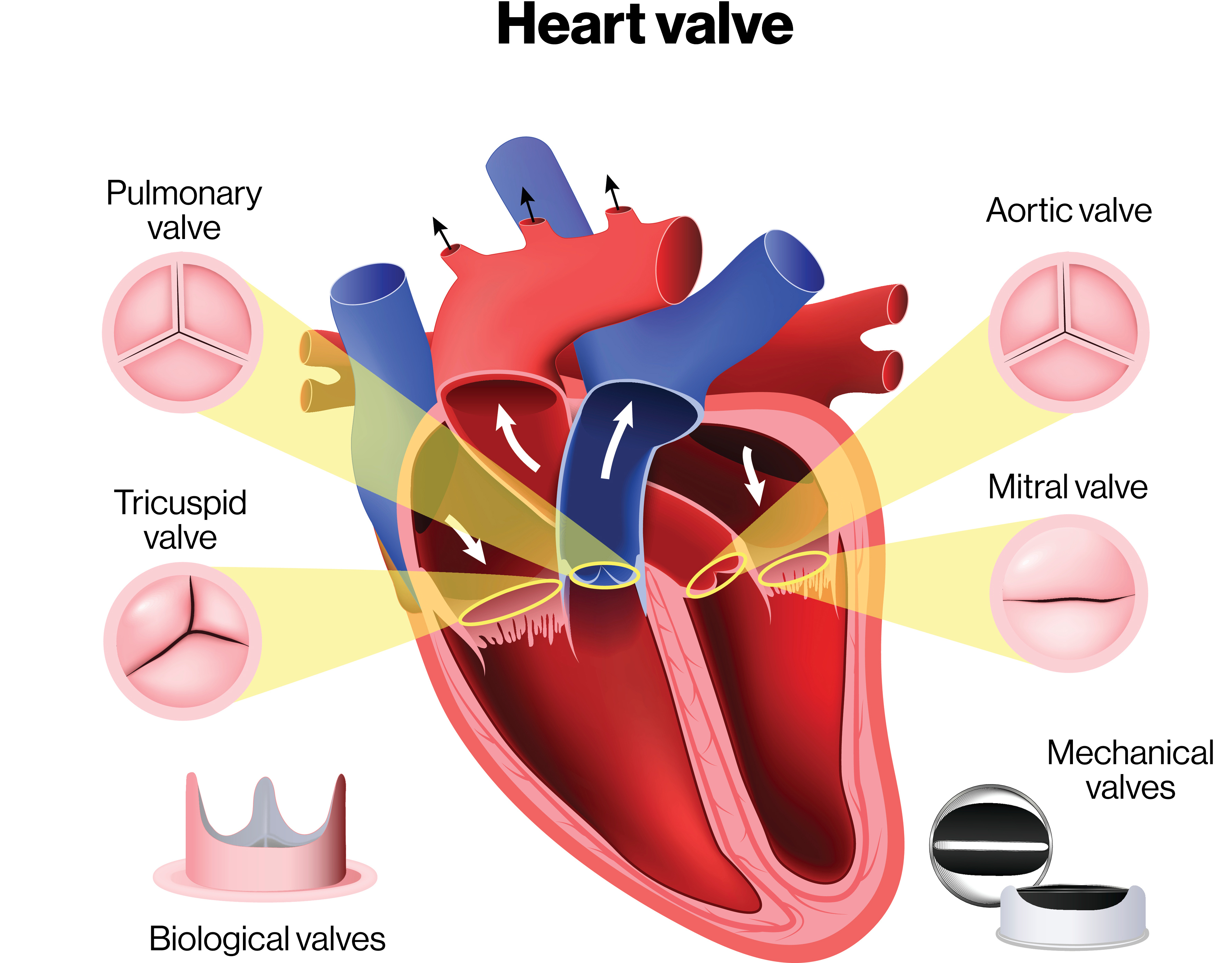Valvular Heart Disease & Prosthetic valves