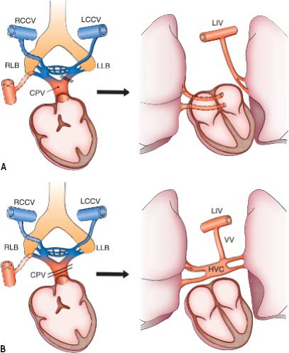 Basic of Anomalies of the Systemic & Pulmonary Veins