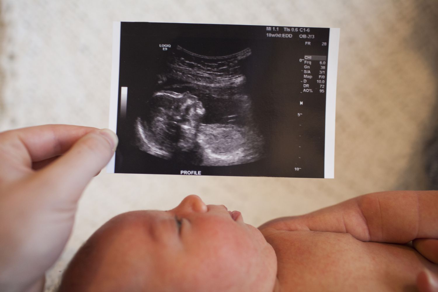 Obstetrical Ultrasound